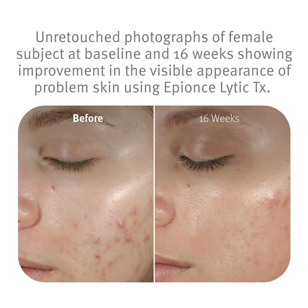 Epionce Epionce Lytic Tx - No Promo Code Needed!